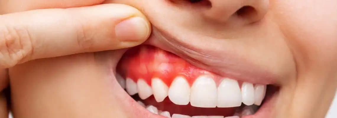 5-effective-ways-to-stop-bleeding-gums-by-dr-shruti-malik
